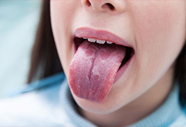 Глоссит, воспаление языка 
